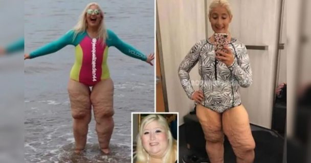 After Wearing A Swimsuit For The First Time In Years, A Woman Who Shed 158 Kg Suffered Body Shame