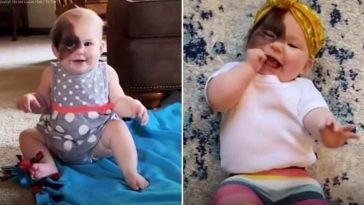 This Mother Is Determined To Make Her Child Feel Beautiful Despite Having An Unusual Birthmark