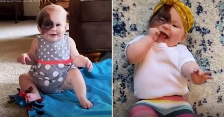 This Mother Is Determined To Make Her Child Feel Beautiful Despite Having An Unusual Birthmark