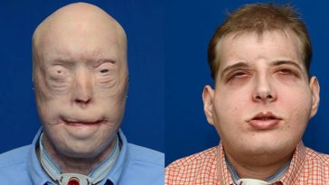 A Firefighter Has The Most Extensive Face Transplant In History, Giving Him A New Life