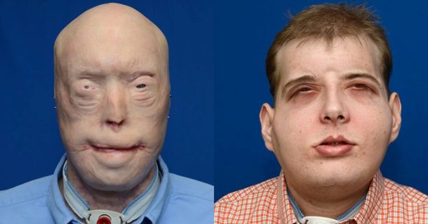 A Firefighter Has The Most Extensive Face Transplant In History, Giving Him A New Life