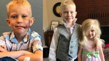 Boy Who Saved Sister From Dangerous Dog Attack Said He's Proud Of His Scar