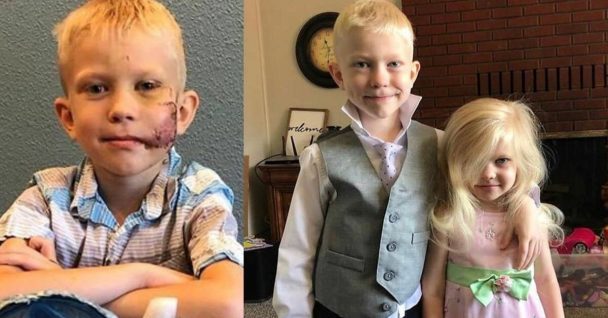Boy Who Saved Sister From Dangerous Dog Attack Said He's Proud Of His Scar